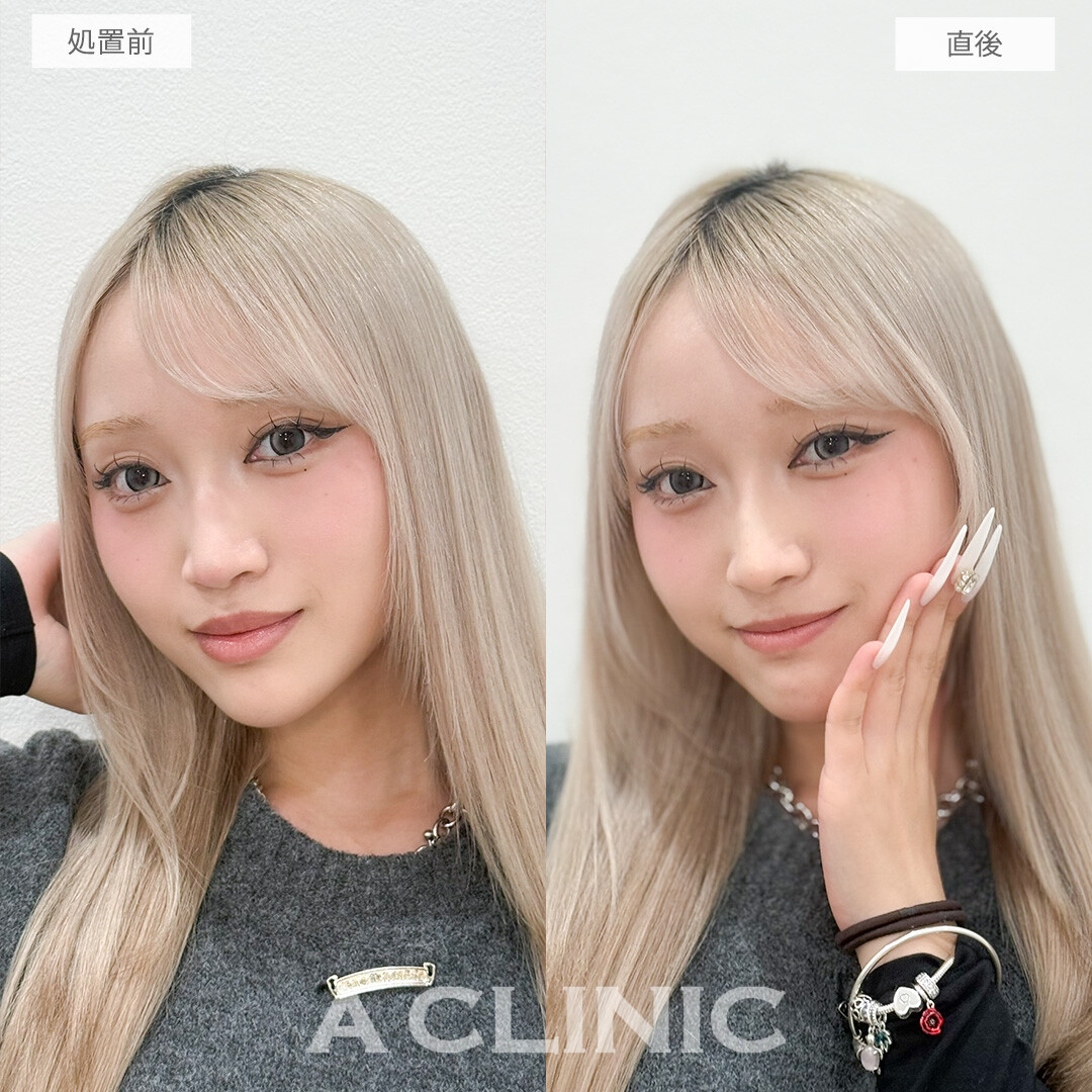 ジャスミンノーズで凹凸をなくして高く真っすぐな鼻筋になれました！処置前と直後の症例です(10代女性)