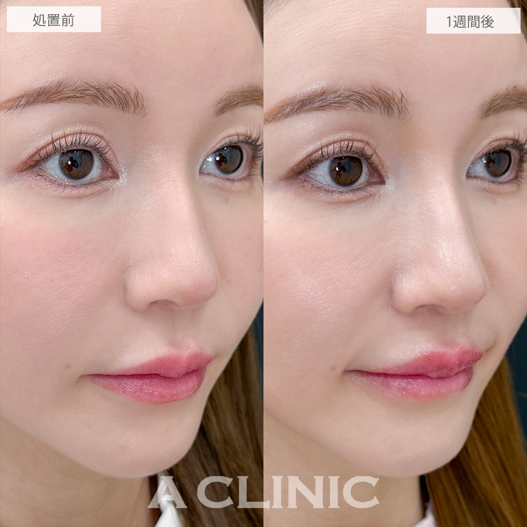 切らない人中短縮で中顔面の間延び感が改善されました！こちら処置前と1週間後の症例です(30代女性)