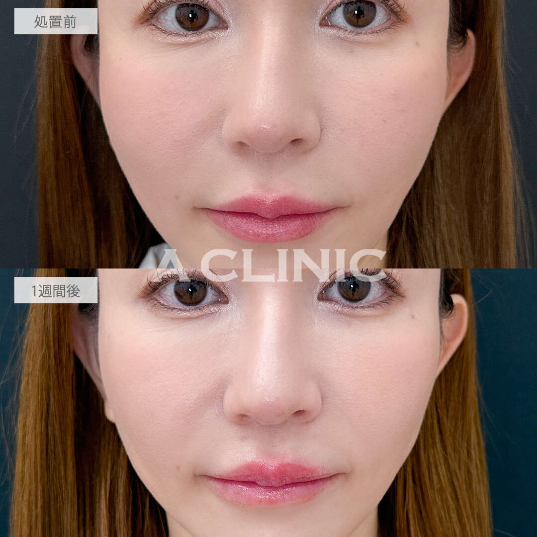 切らない人中短縮で中顔面の間延び感が改善されました！こちら処置前と1週間後の症例です(30代女性)