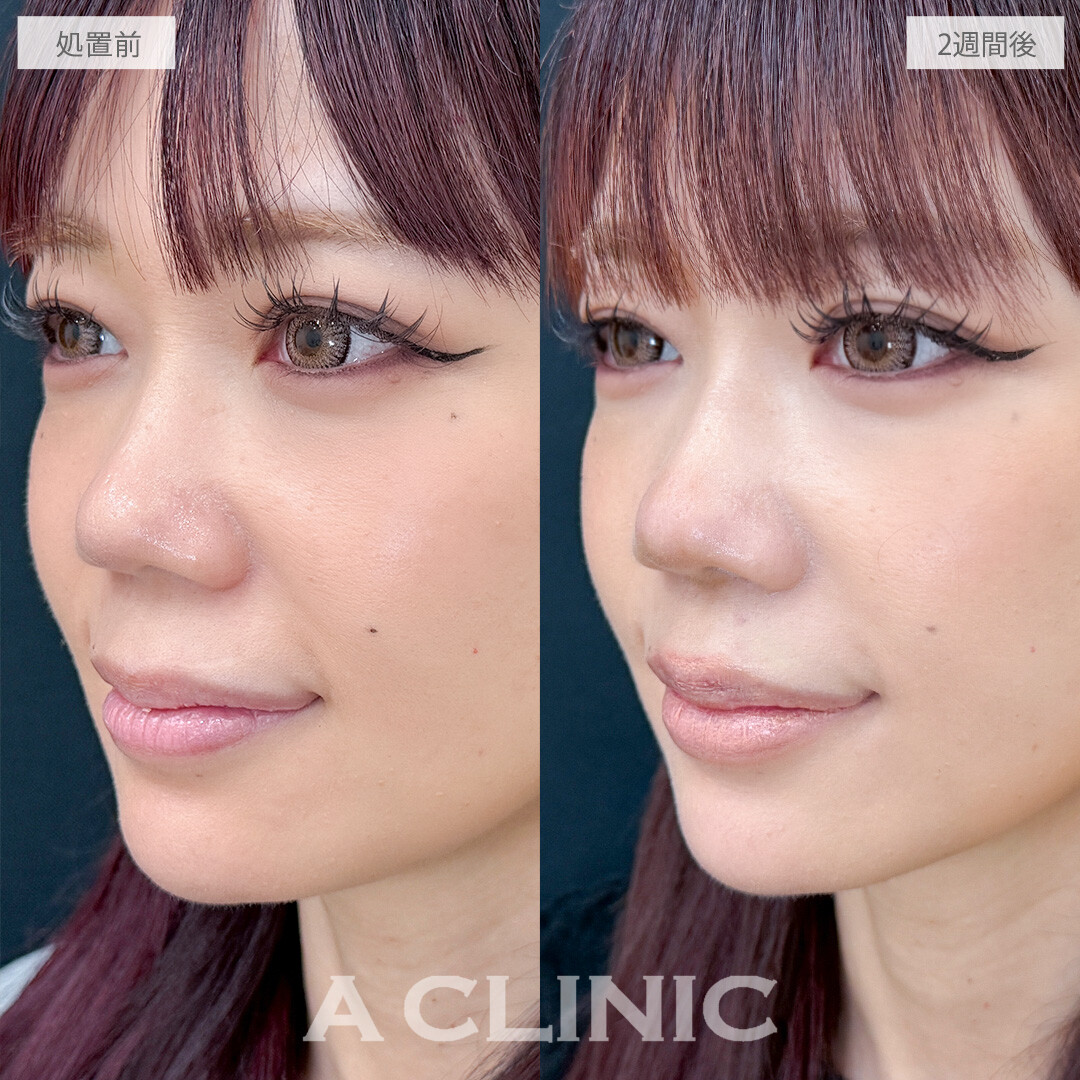 切らない人中短縮(Cカール形成術)なら傷跡ナシで垢抜けられます！こちら処置前と2週間後の症例です(30代女性)