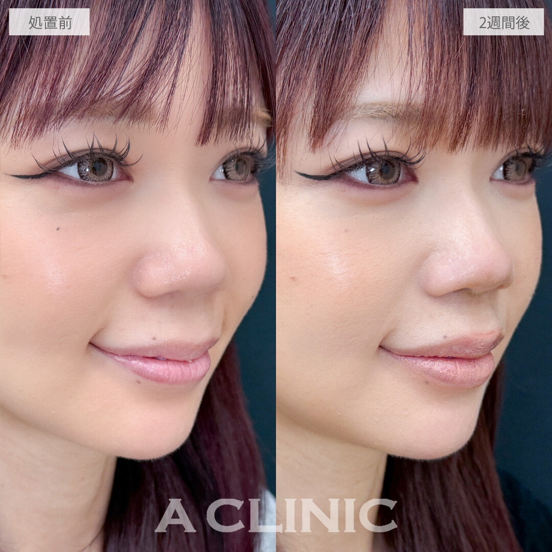 切らない人中短縮(Cカール形成術)なら傷跡ナシで垢抜けられます！こちら処置前と2週間後の症例です(30代女性)