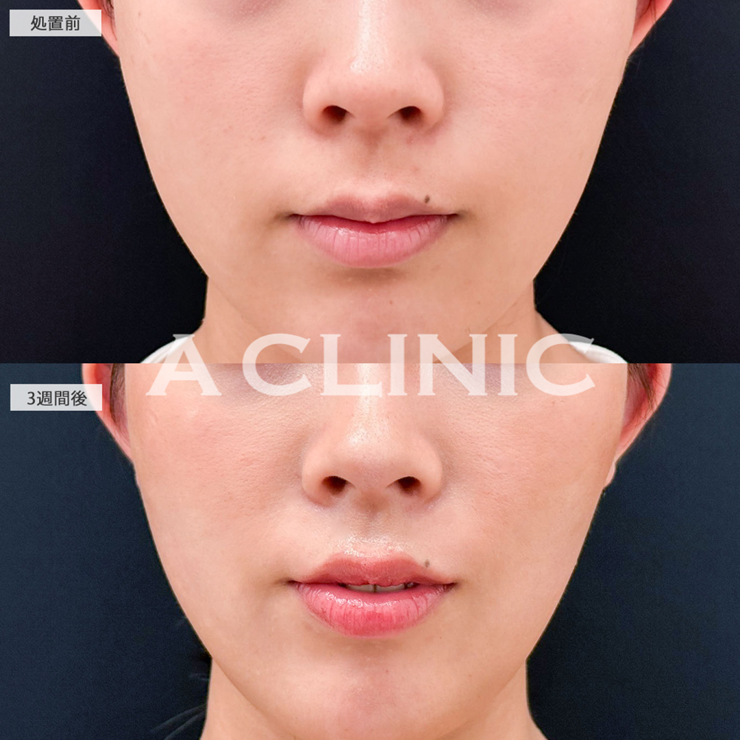 切らない人中短縮(Cカール形成術)で中顔面が短くなりました！こちら処置前と3週間後の症例です(20代女性)