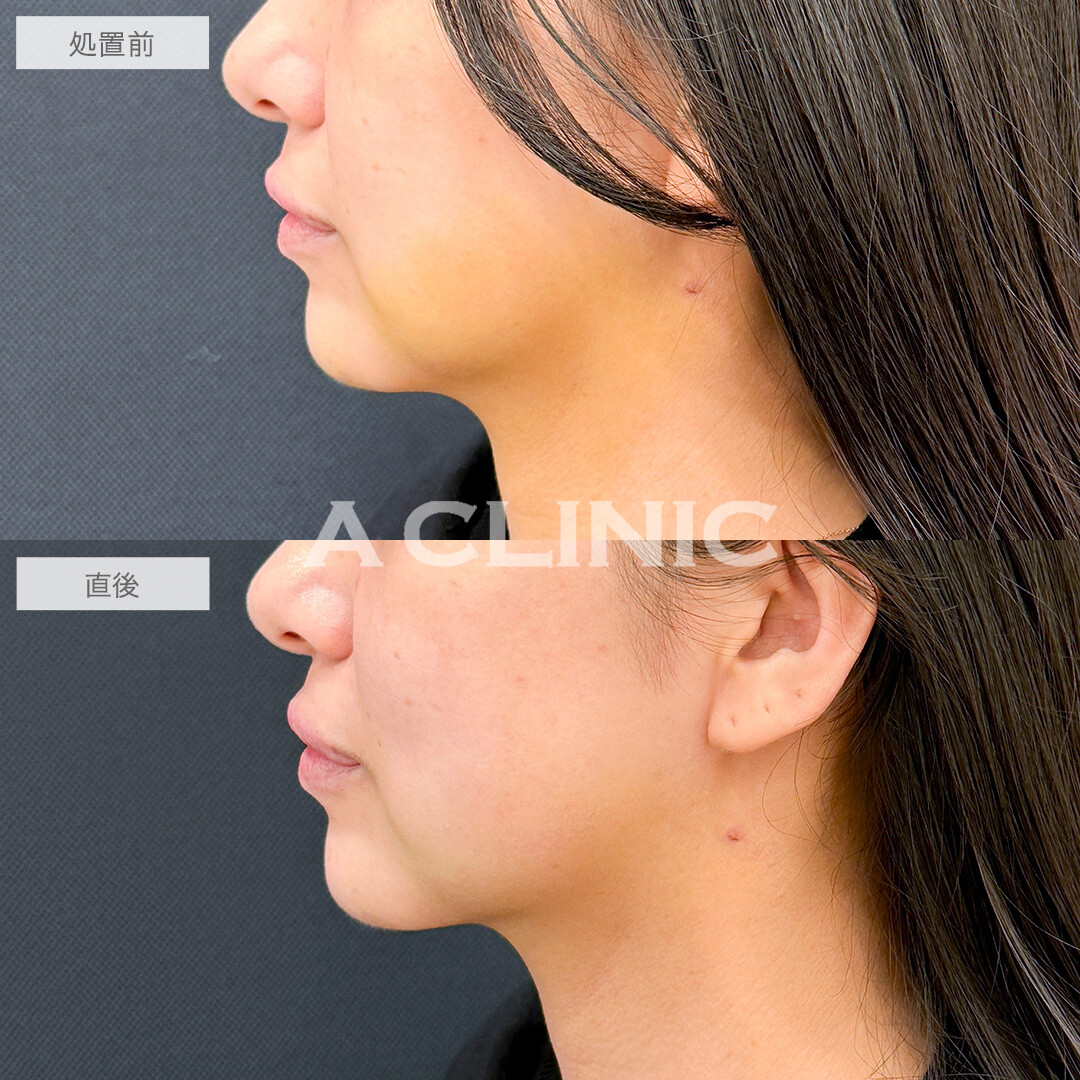 KOライトで内出血が薄くなりました！処置前と直後の症例です(30代女性)