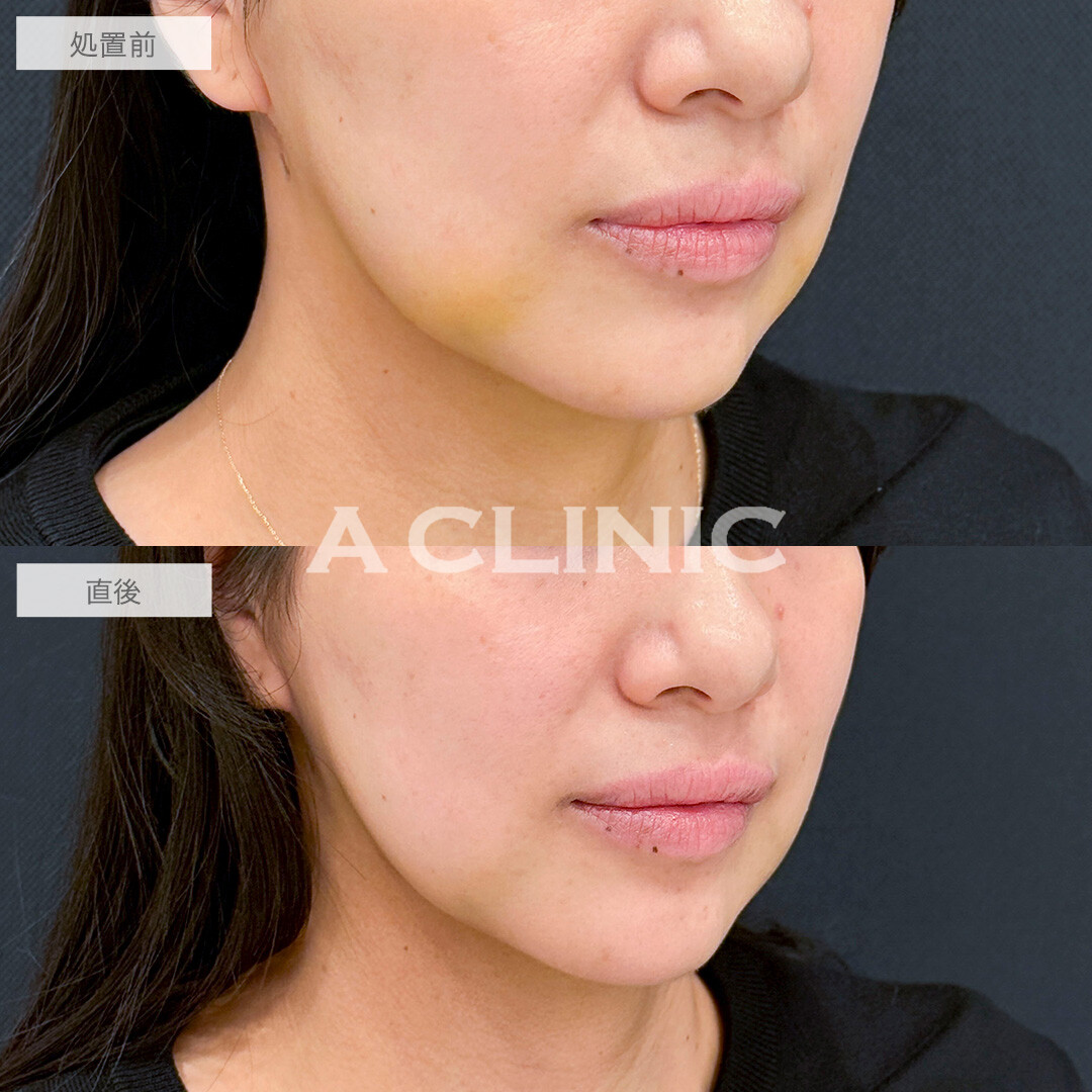 KOライトで内出血が薄くなりました！処置前と直後の症例です(30代女性)