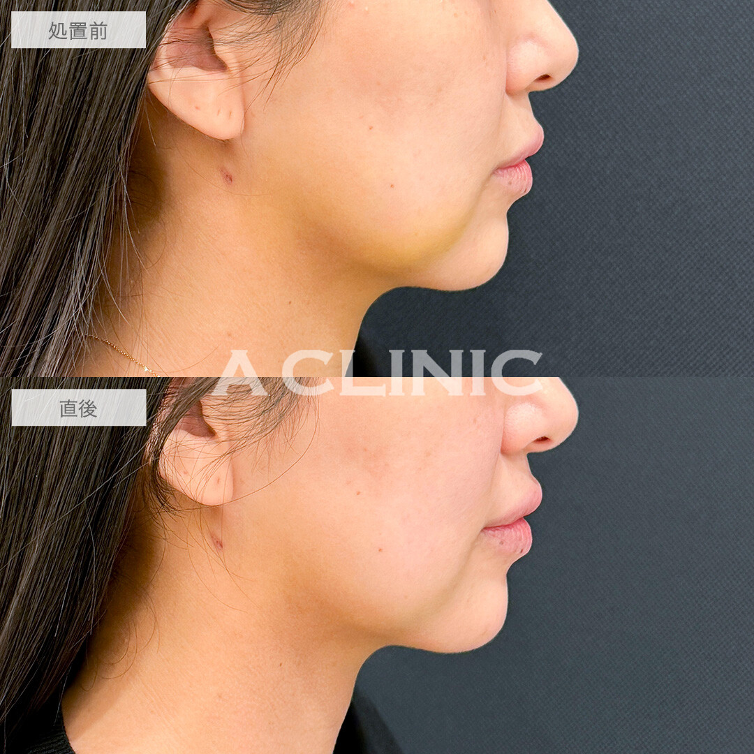 KOライトで内出血が薄くなりました！処置前と直後の症例です(30代女性)