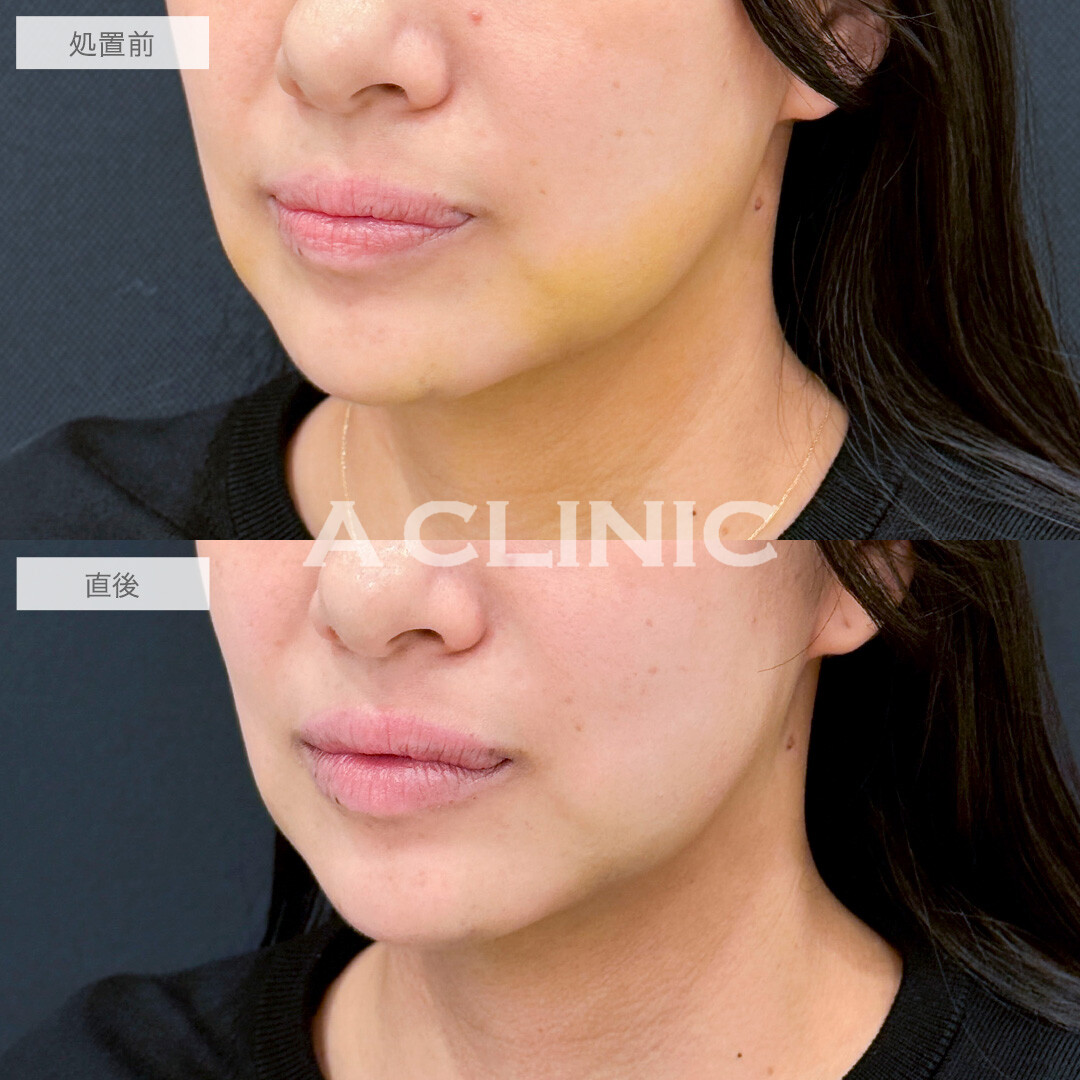 KOライトで内出血が薄くなりました！処置前と直後の症例です(30代女性)