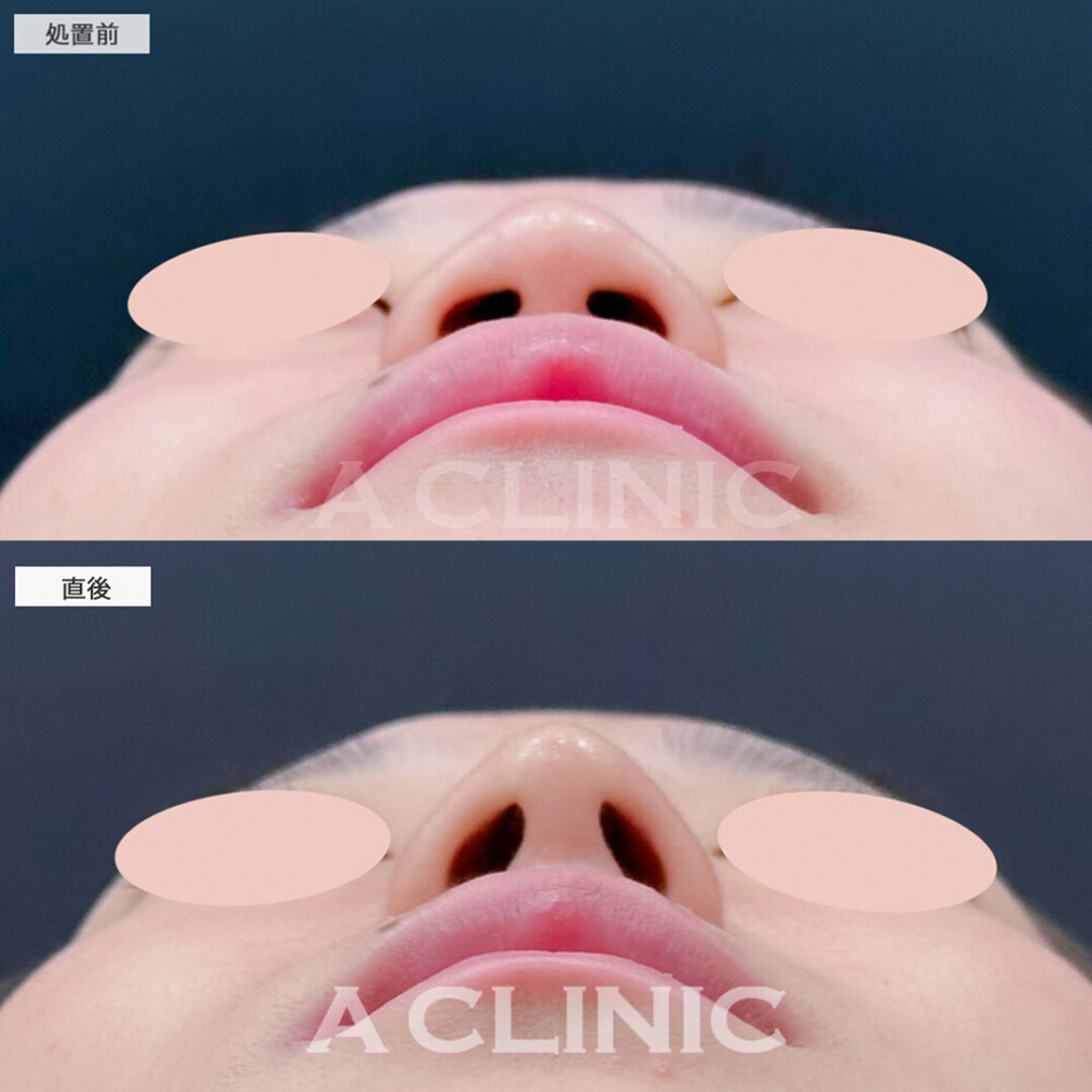 コリアンノーズで直後から韓国アイドルのような自然なアップノーズになりました！こちら処置前と直後の症例です(10代女性)