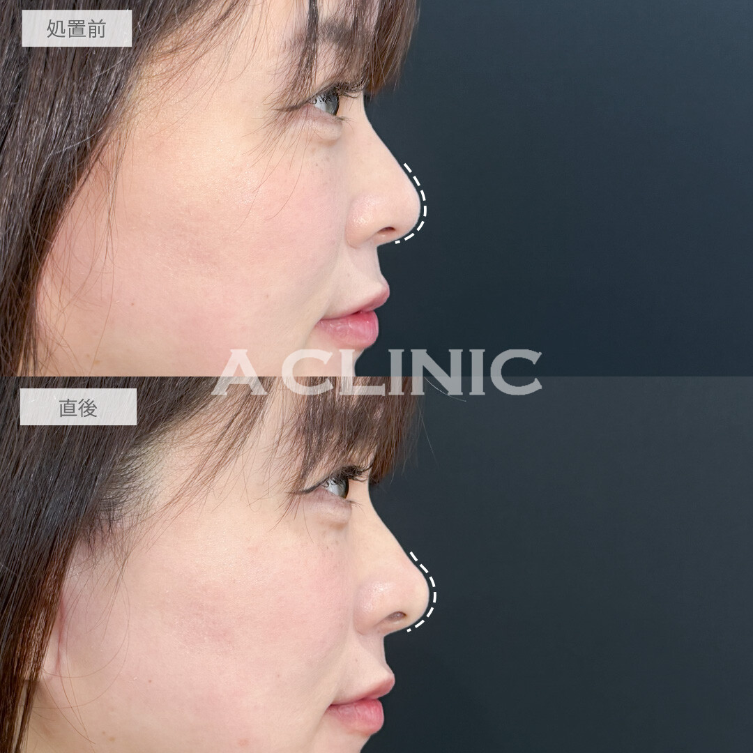 コリアンノーズでアップノーズになり今どきのオシャレ顔になりました！処置前と直後の症例です(30代女性)