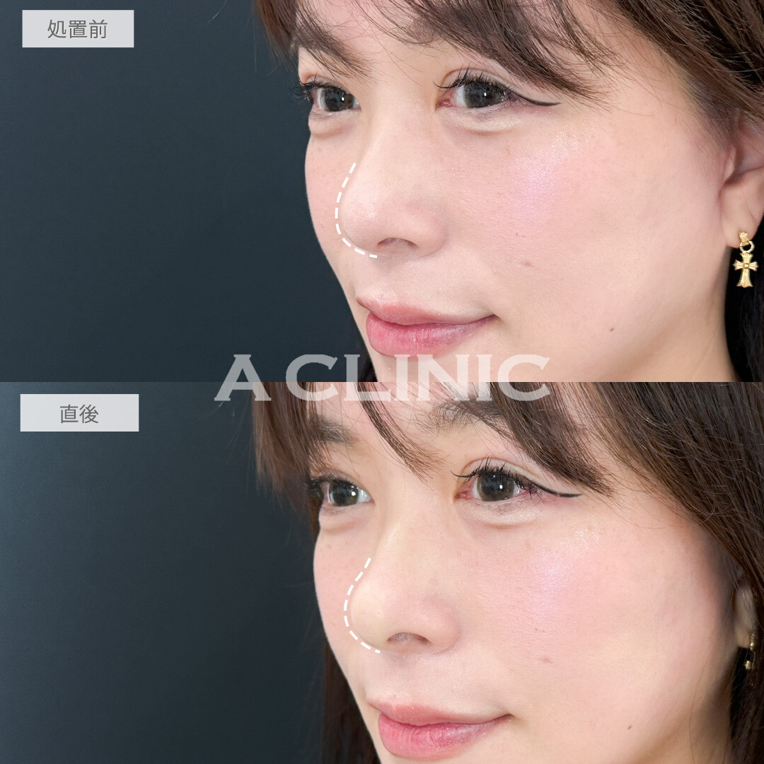 コリアンノーズでアップノーズになり今どきのオシャレ顔になりました！処置前と直後の症例です(30代女性)
