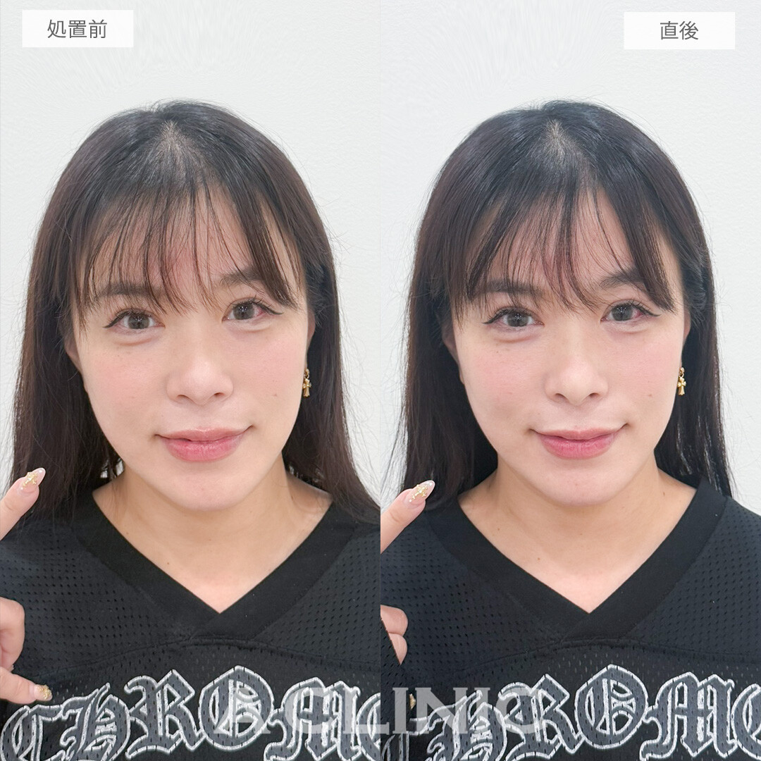 コリアンノーズでアップノーズになり今どきのオシャレ顔になりました！処置前と直後の症例です(30代女性)