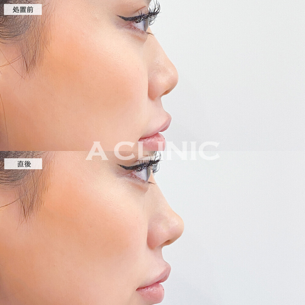 コリアンノーズでツンとした鼻先になることで大人っぽい印象に！こちら処置前と直後の症例です(20代女性)