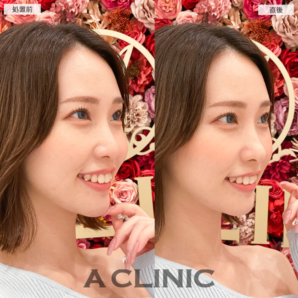 コリアンノーズで鼻先が高くなりお顔全体がシュッとした印象に！こちら処置前と直後の症例です(20代女性)