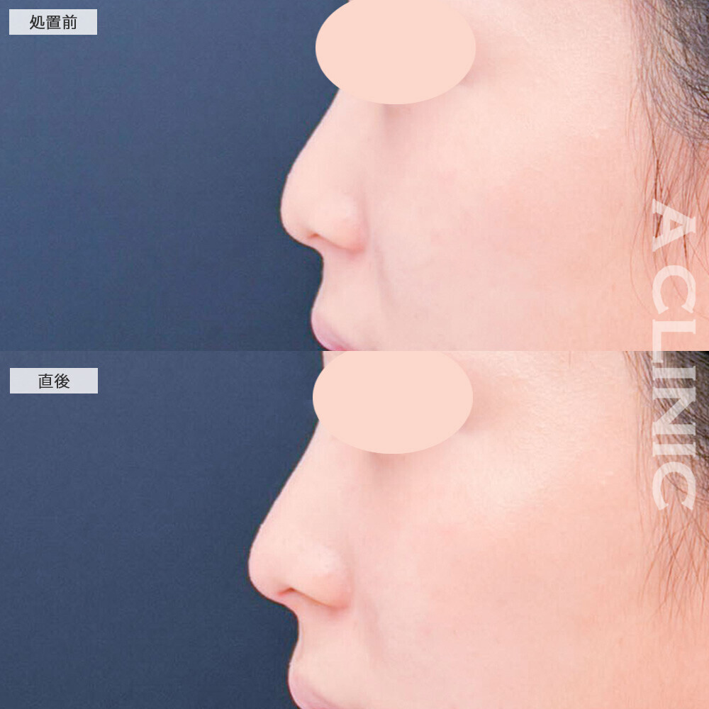 コリアンノーズで理想通りの高さの鼻先になりました！こちら処置前と直後の症例です(20代女性)