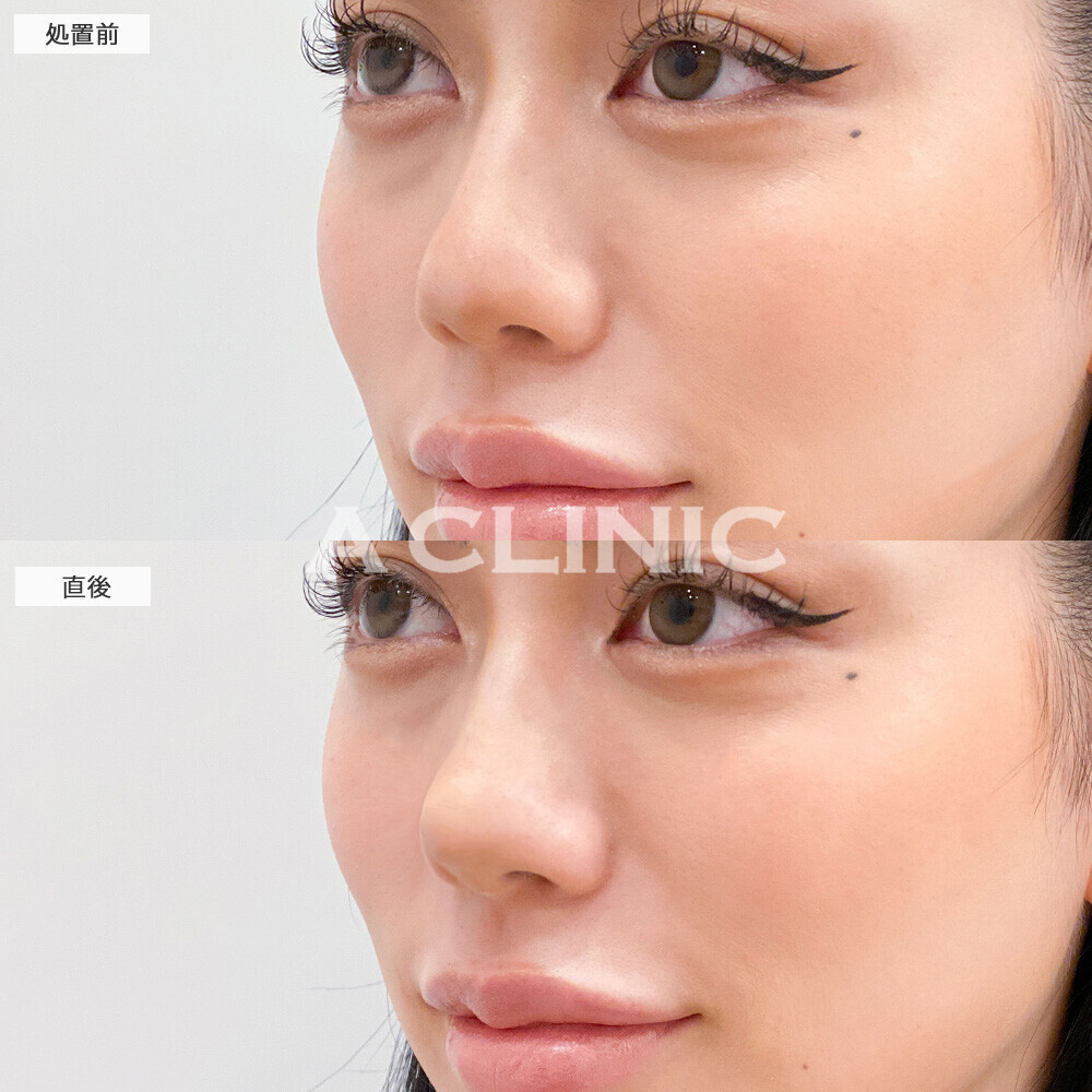 コリアンノーズでツンとした鼻先になることで大人っぽい印象に！こちら処置前と直後の症例です(20代女性)