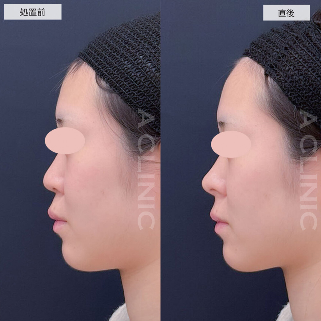 コリアンノーズで直後から韓国アイドルのような自然なアップノーズになりました！こちら処置前と直後の症例です(10代女性)