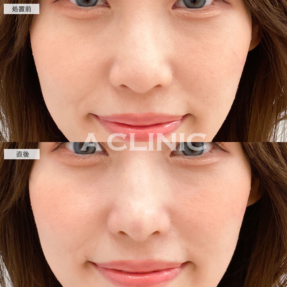 コリアンノーズで鼻先が高くなりお顔全体がシュッとした印象に！こちら処置前と直後の症例です(20代女性)