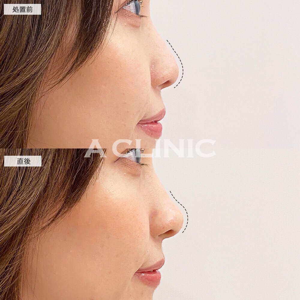 コリアンノーズで鼻先が高くなりお顔全体がシュッとした印象に！こちら処置前と直後の症例です(20代女性)