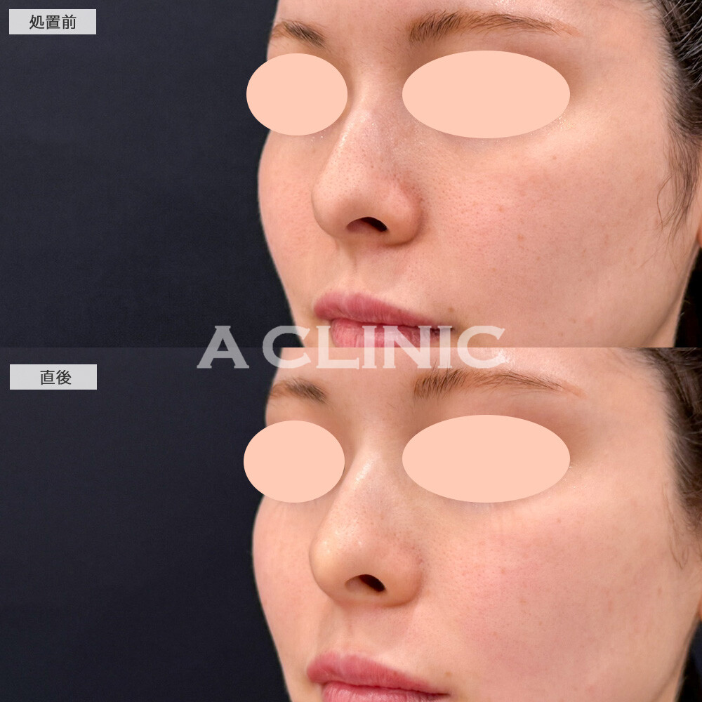 コリアンノーズで元々綺麗な鼻が、より高さのある鼻に生まれ変わりました！こちら処置前と直後の症例です(20代女性)