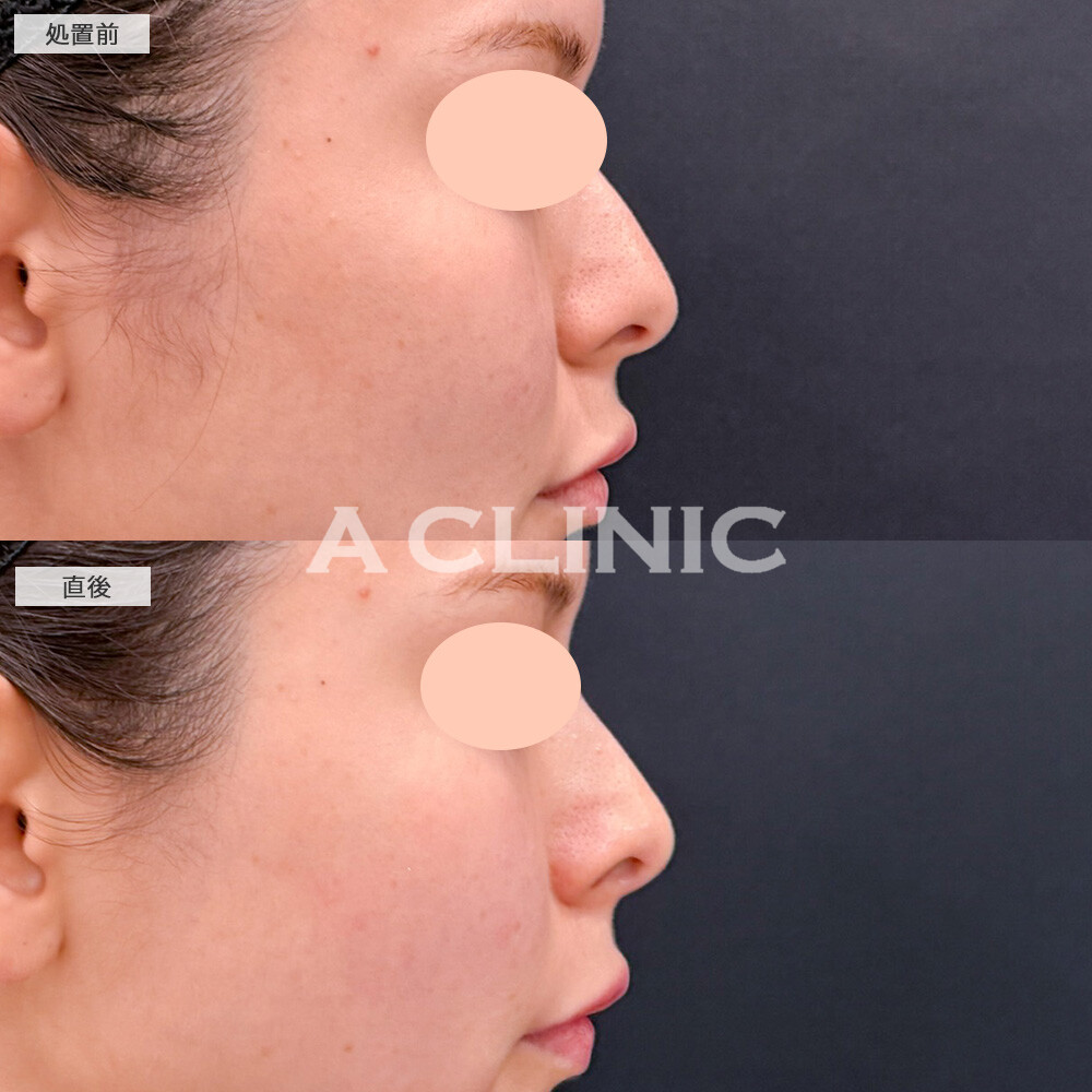 コリアンノーズで元々綺麗な鼻が、より高さのある鼻に生まれ変わりました！こちら処置前と直後の症例です(20代女性)