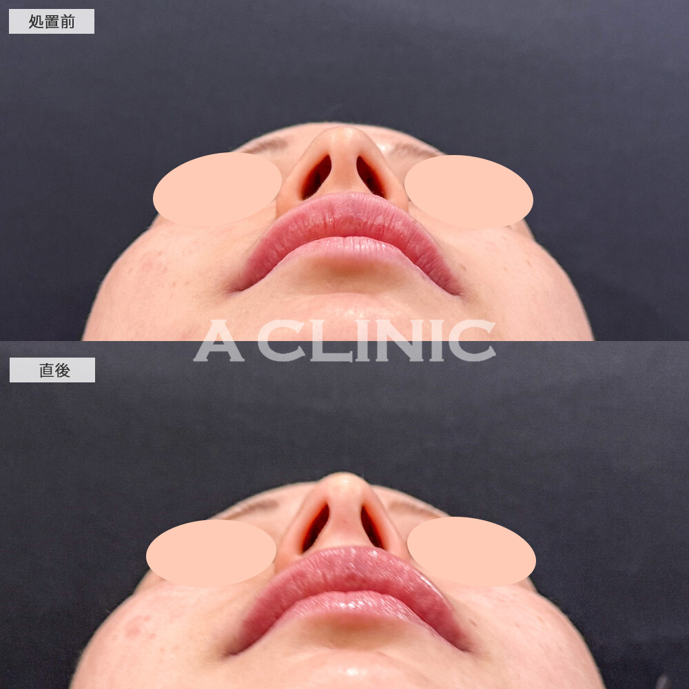 コリアンノーズで元々綺麗な鼻が、より高さのある鼻に生まれ変わりました！こちら処置前と直後の症例です(20代女性)