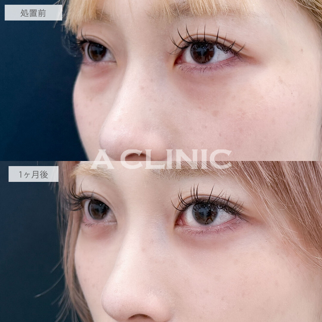 目の下のクマ取りで目元を明るくしお顔の印象まで変わりました！こちら処置前と1ヶ月後の症例です(20代女性)