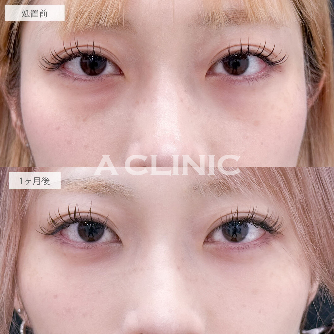 目の下のクマ取りで目元を明るくしお顔の印象まで変わりました！こちら処置前と1ヶ月後の症例です(20代女性)