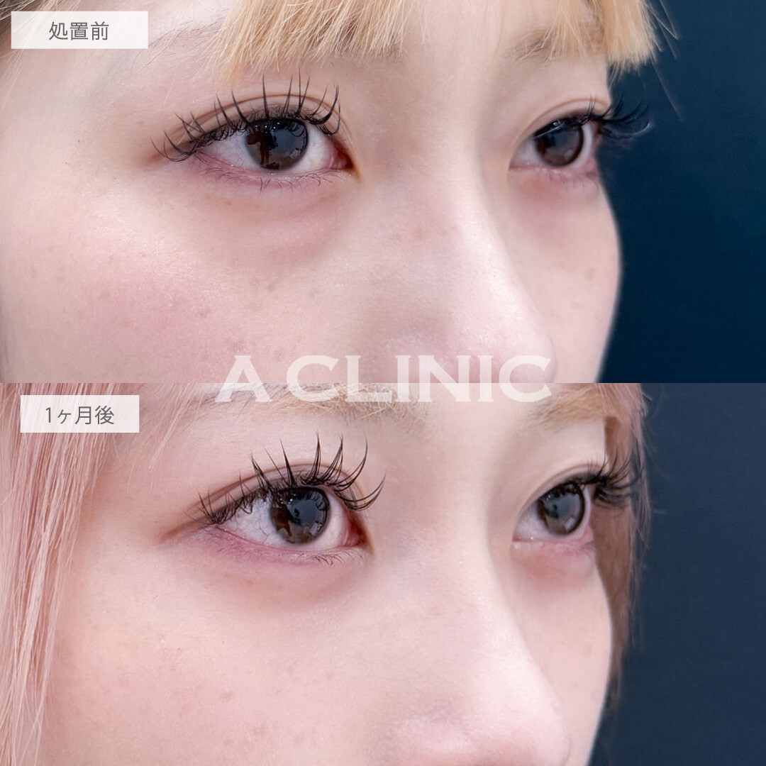 目の下のクマ取りで目元を明るくしお顔の印象まで変わりました！こちら処置前と1ヶ月後の症例です(20代女性)