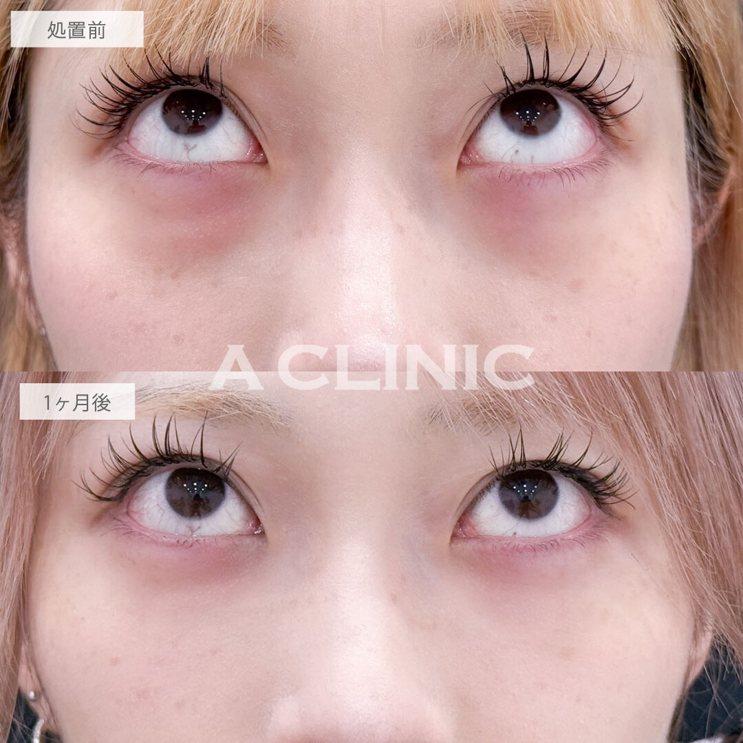 目の下のクマ取りで目元を明るくしお顔の印象まで変わりました！こちら処置前と1ヶ月後の症例です(20代女性)