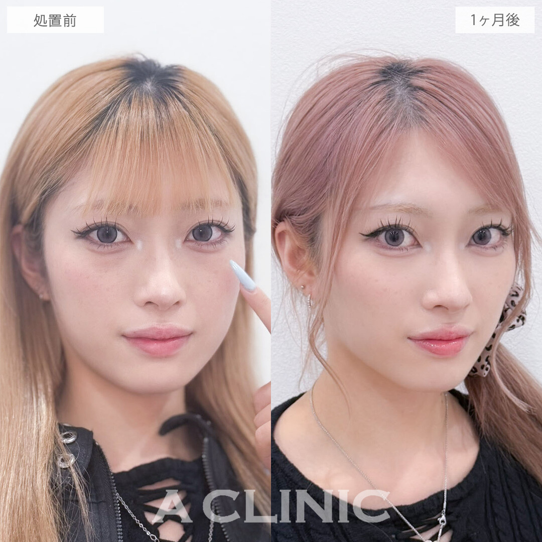 目の下のクマ取りで目元を明るくしお顔の印象まで変わりました！こちら処置前と1ヶ月後の症例です(20代女性)
