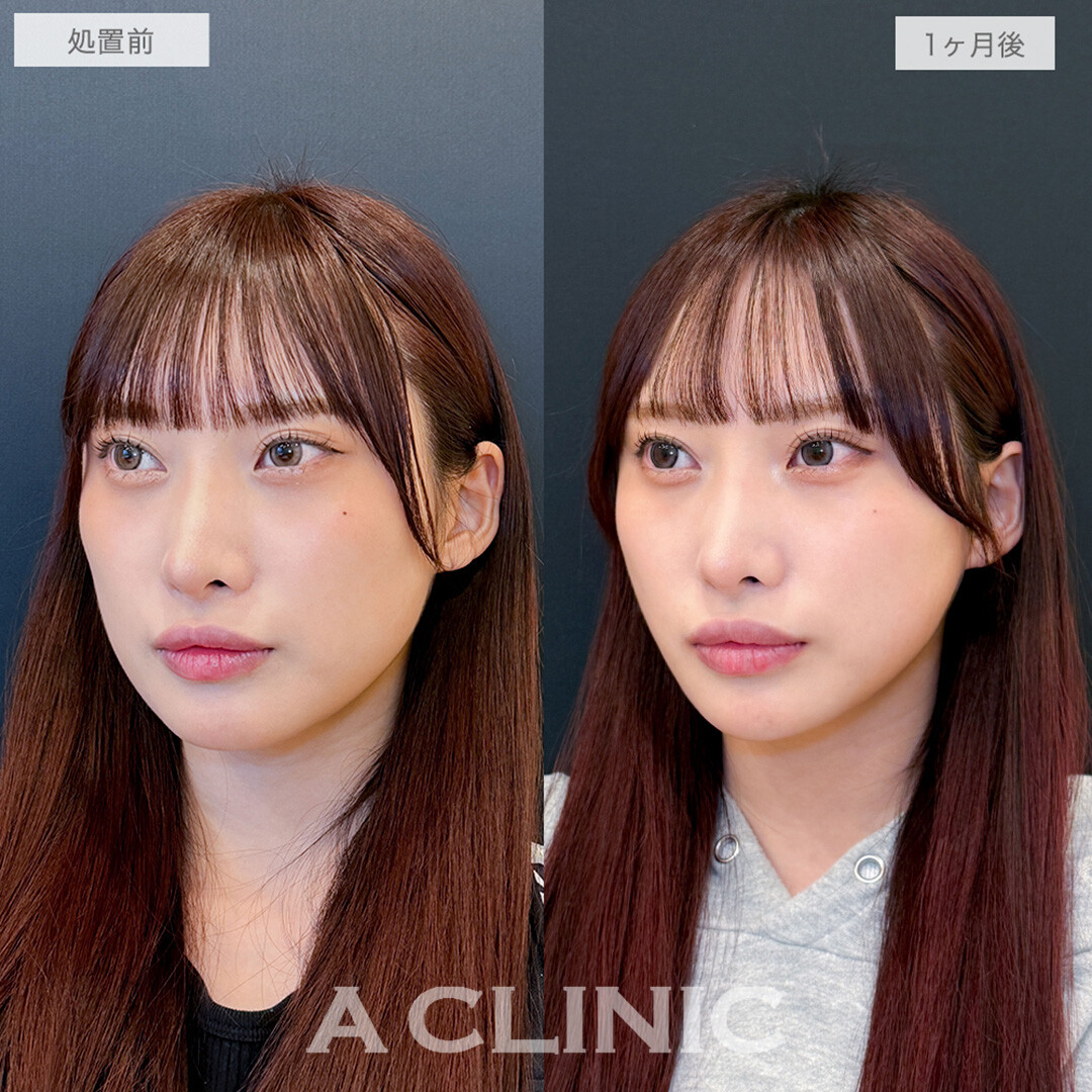 1day小顔脂肪吸引で輪郭が整い美人度がさらにパワーアップ！処置前と1ヶ月後の症例です(20代女性)