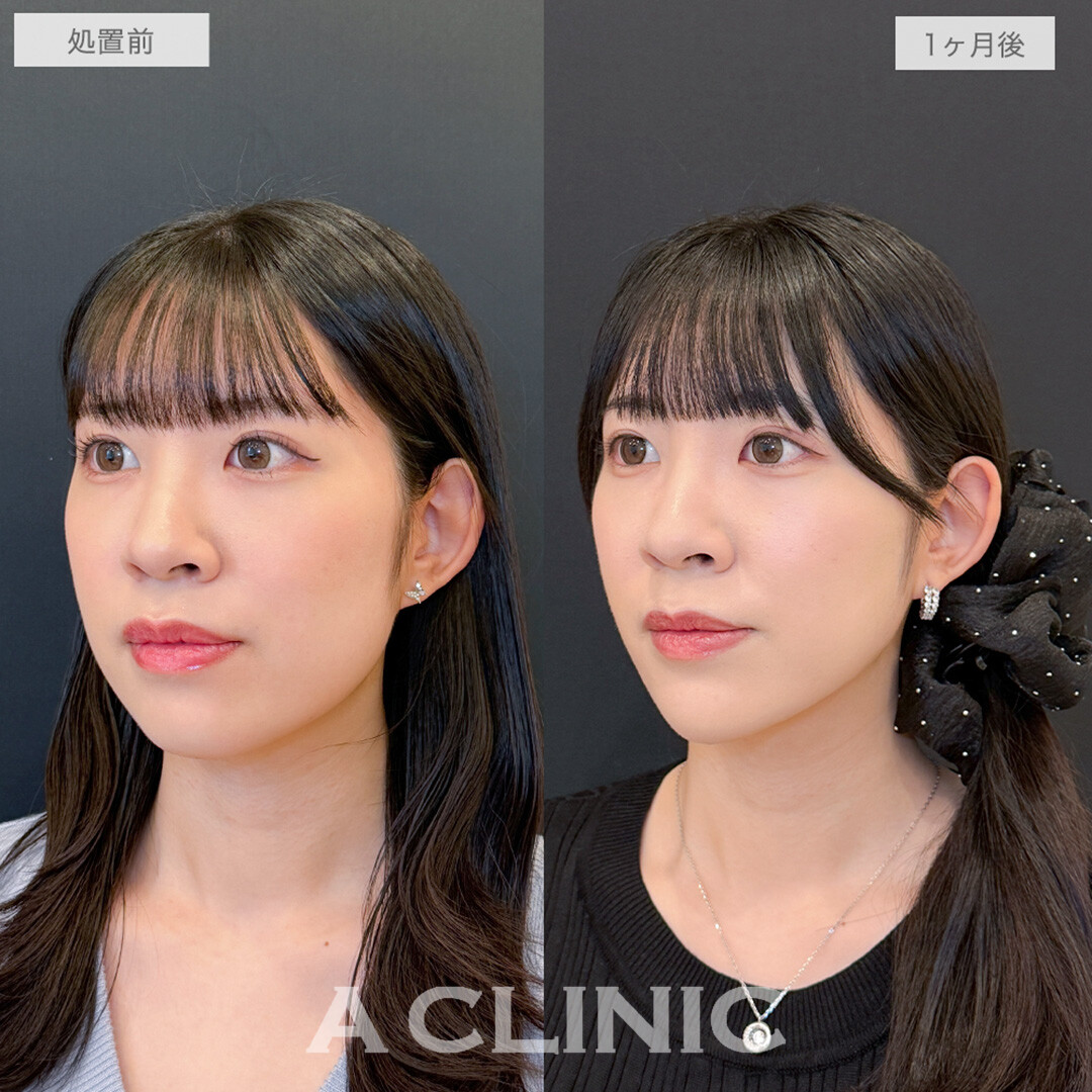 1day小顔脂肪吸引と小顔エラボトックスとあごへのヒアルロン酸注入でフェイスラインのもたつきが消え綺麗なVフェイスが誕生！処置前と1ヶ月後の症例です(20代女性)