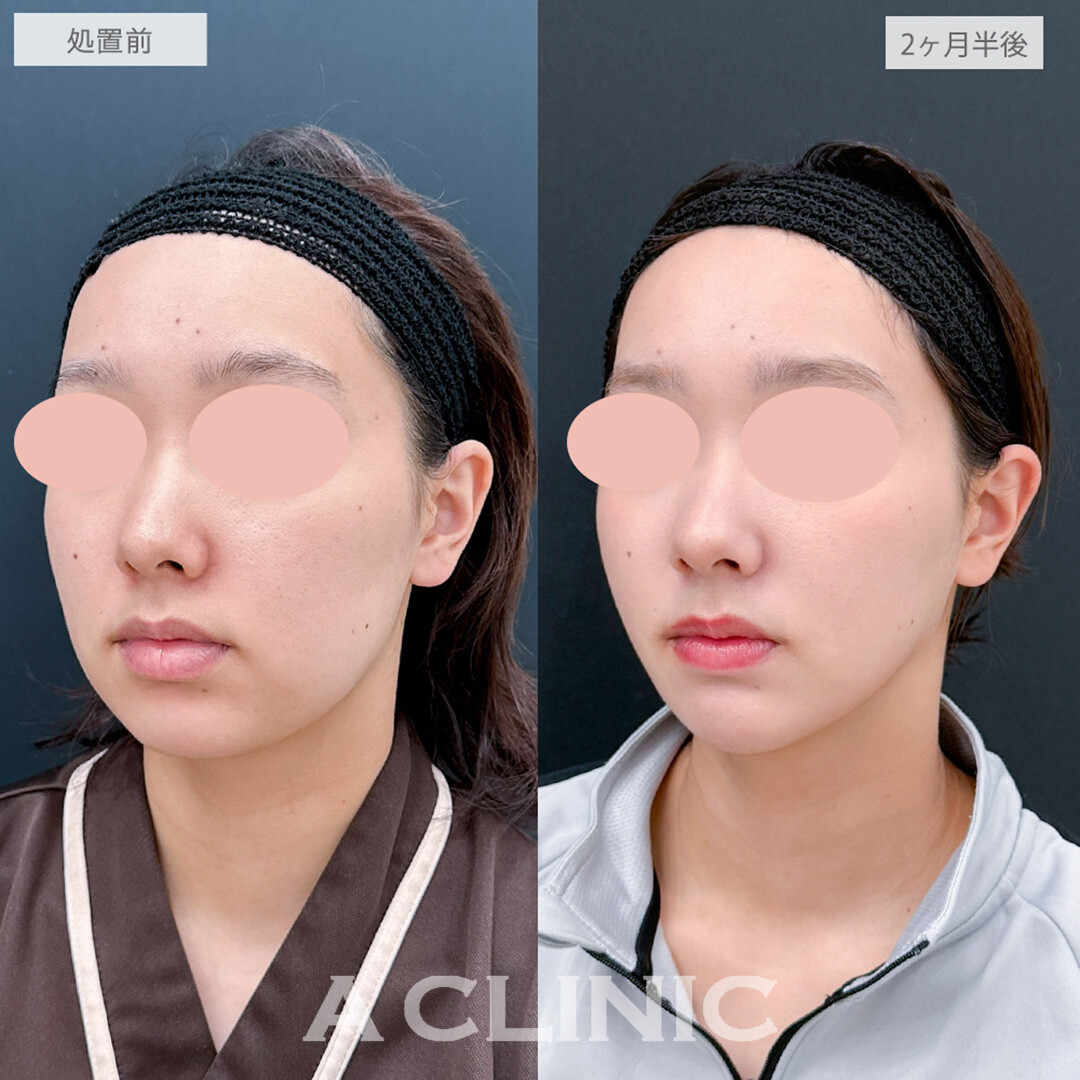 1day小顔脂肪吸引と小顔エラボトックスとあごへのヒアルロン酸注入とボトックス注射(しわ)でぼやけていた輪郭がくっきりとシャープなお顔になりました！処置前と2ヶ月半後の症例です(20代女性)