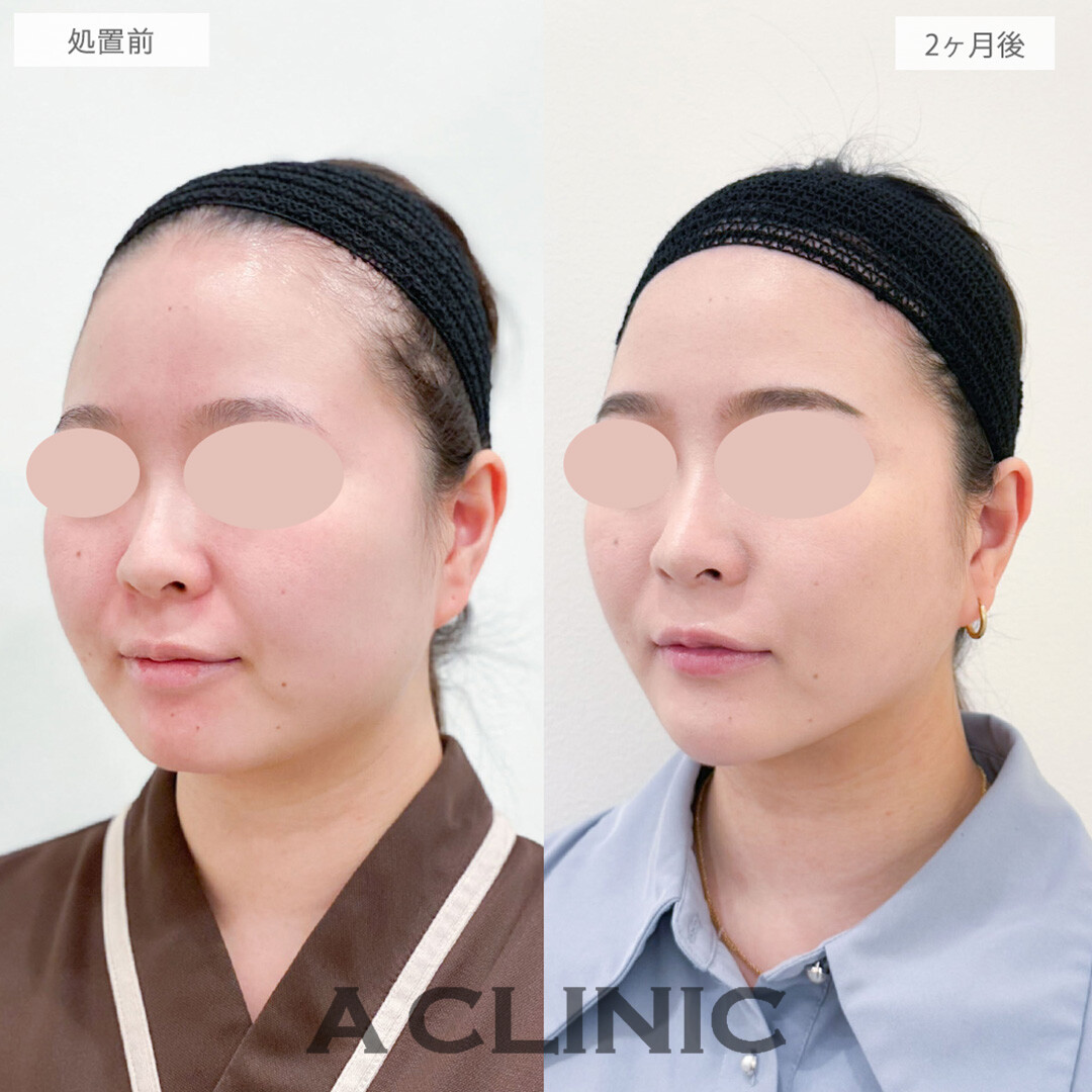 1day小顔脂肪吸引とバッカルファット除去術とナゾラビアルファット除去術と小顔エラボトックスとあごへのヒアルロン酸注入で骨切りいらずの理想の小顔を手に入れました！処置前と2ヶ月後の症例です(20代女性)