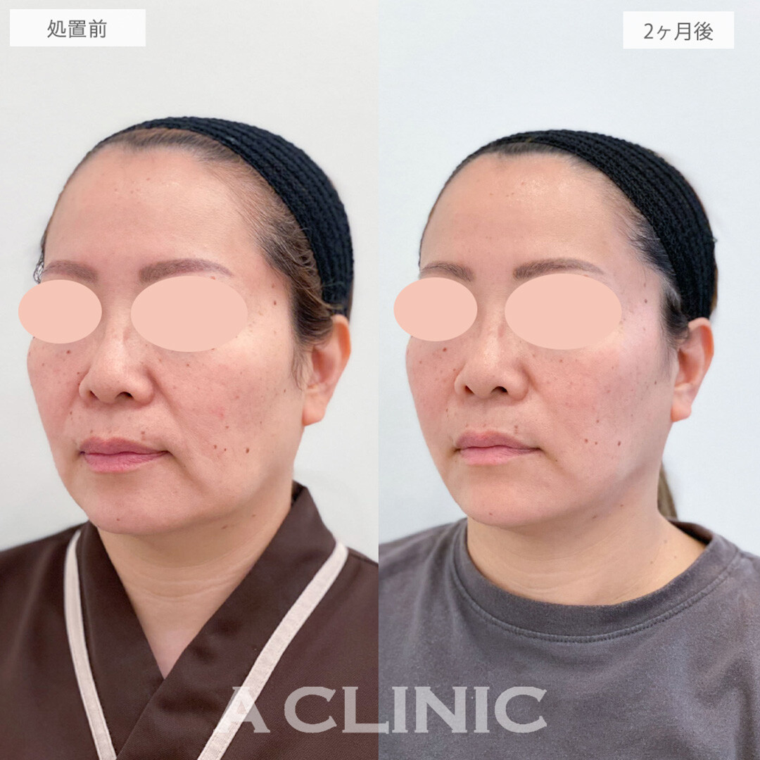 1day小顔脂肪吸引とあごへのヒアルロン酸注入とボトックス注射(しわ)でたるみとシワが改善され若々しい印象になりました！処置前と2ヶ月後の症例です(40代女性)