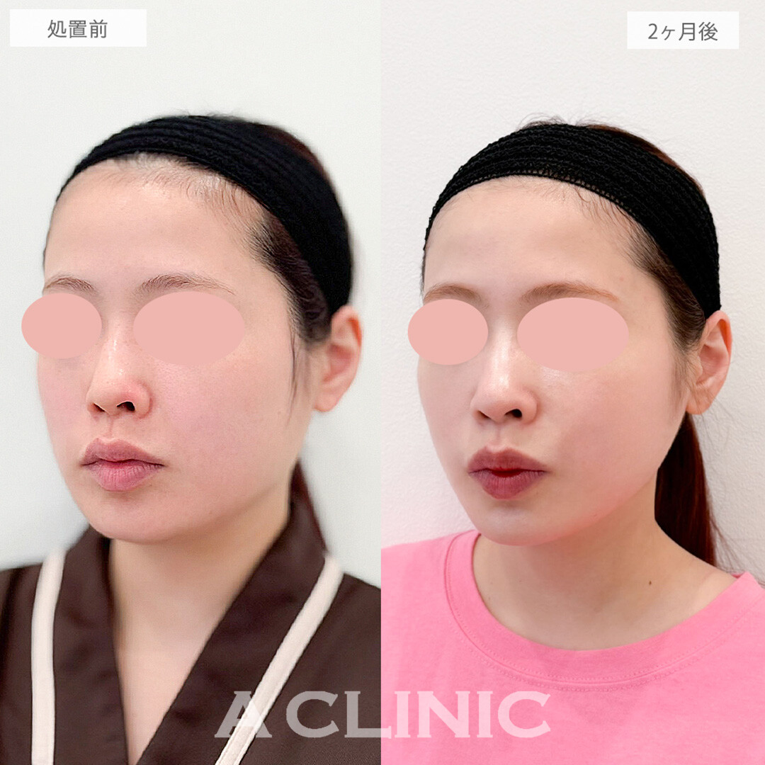1day小顔脂肪吸引と小顔エラボトックスで顔の余白がなくなりスッキリ垢抜けた印象に！処置前と2ヶ月後の症例です(20代女性)