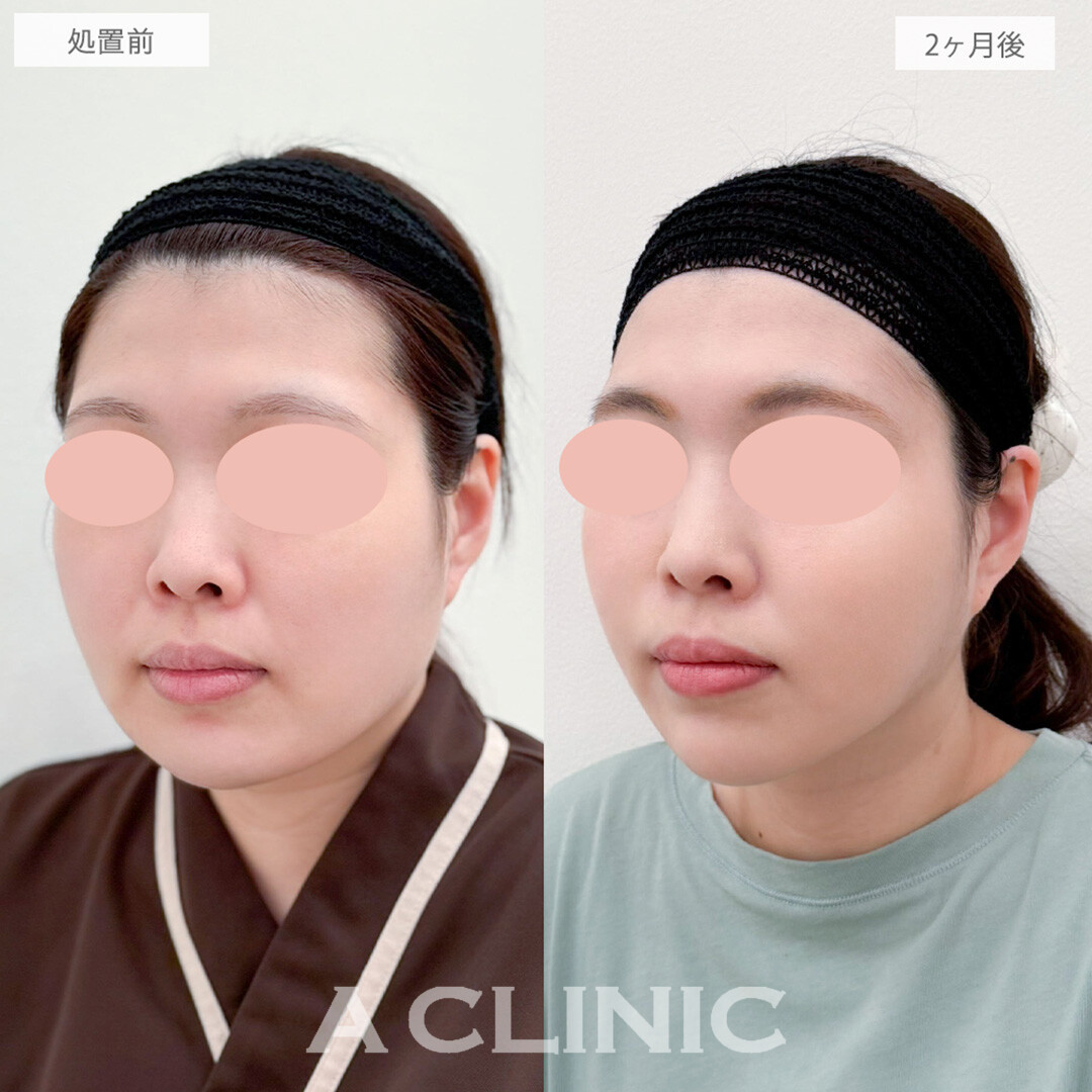 1day小顔脂肪吸引と小顔エラボトックスで下膨れ顔から輪郭美人に！処置前と2ヶ月後の症例です(30代女性)