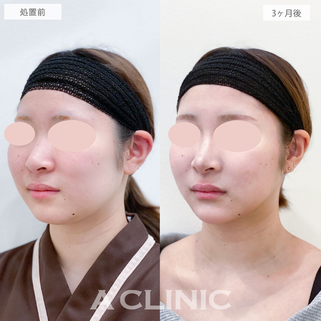 1day小顔脂肪吸引と小顔エラボトックスとあごへのヒアルロン酸注入で垢抜け輪郭が手に入りました！処置前と3ヶ月後の症例です(20代女性)