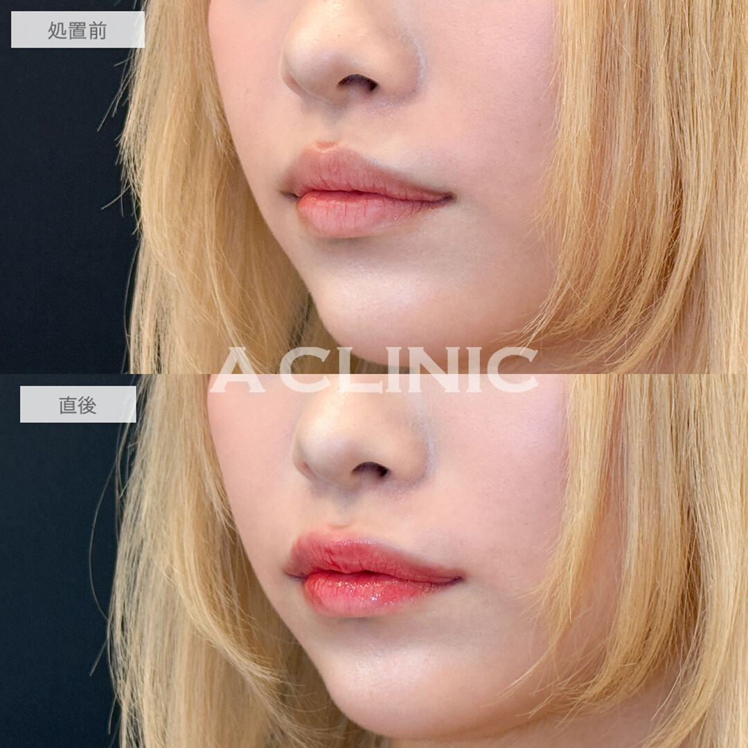 スマイルリップで加工後のような唇が手に入りました！処置前と直後の症例です(10代女性)