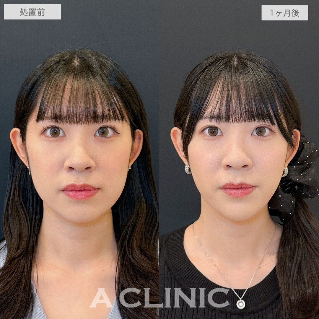 1day小顔脂肪吸引と小顔エラボトックスとあごへのヒアルロン酸注入でフェイスラインのもたつきが消え綺麗なVフェイスが誕生！処置前と1ヶ月後の症例です(20代女性)