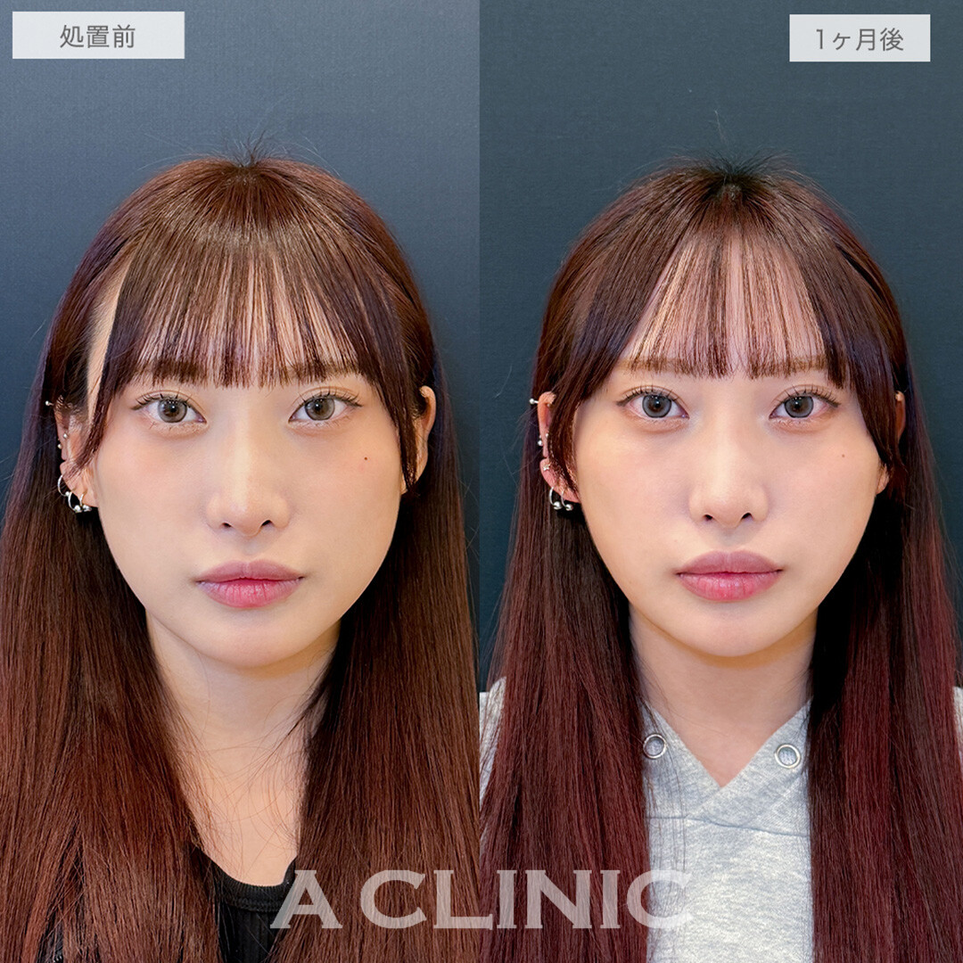 1day小顔脂肪吸引で輪郭が整い美人度がさらにパワーアップ！処置前と1ヶ月後の症例です(20代女性)