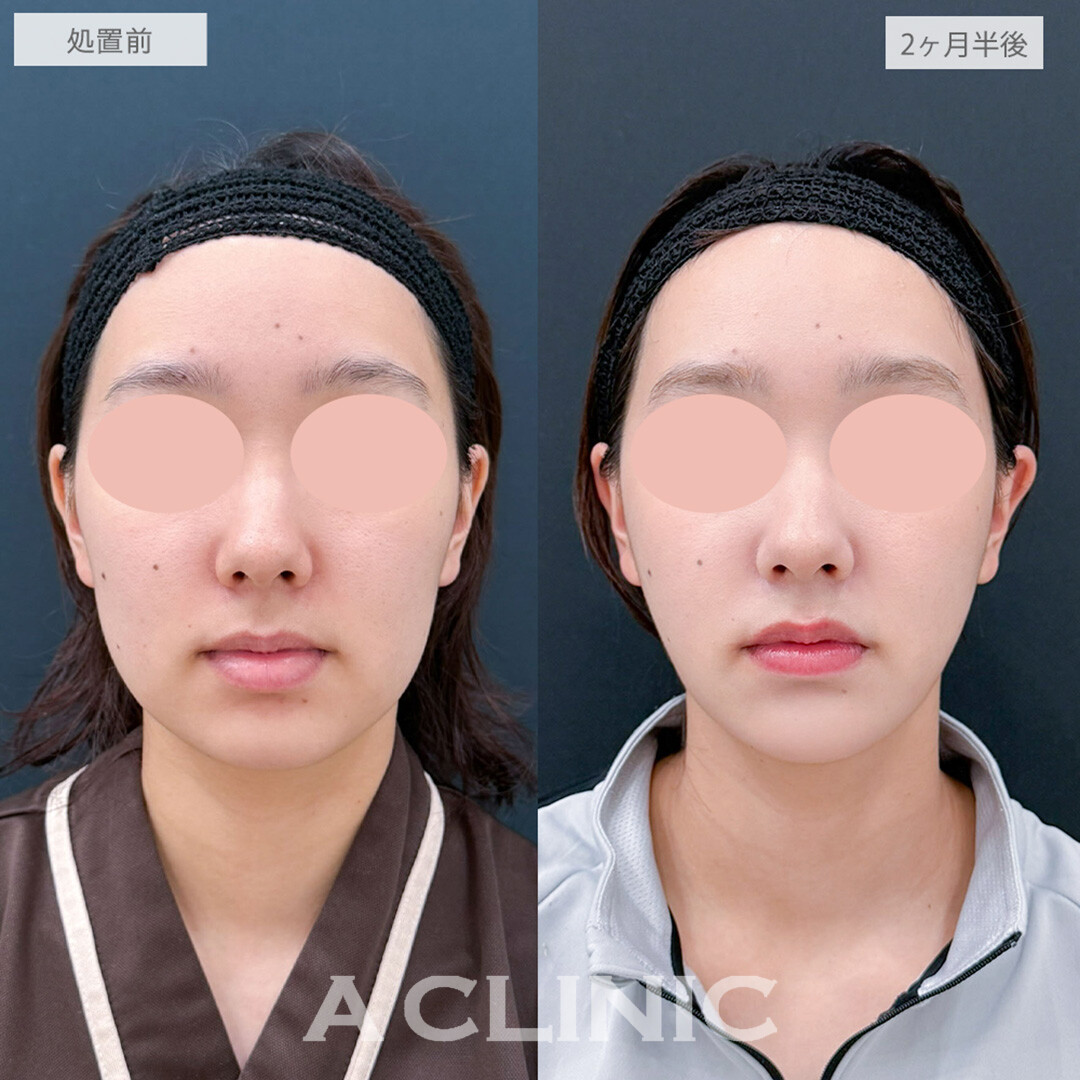 1day小顔脂肪吸引と小顔エラボトックスとあごへのヒアルロン酸注入とボトックス注射(しわ)でぼやけていた輪郭がくっきりとシャープなお顔になりました！処置前と2ヶ月半後の症例です(20代女性)