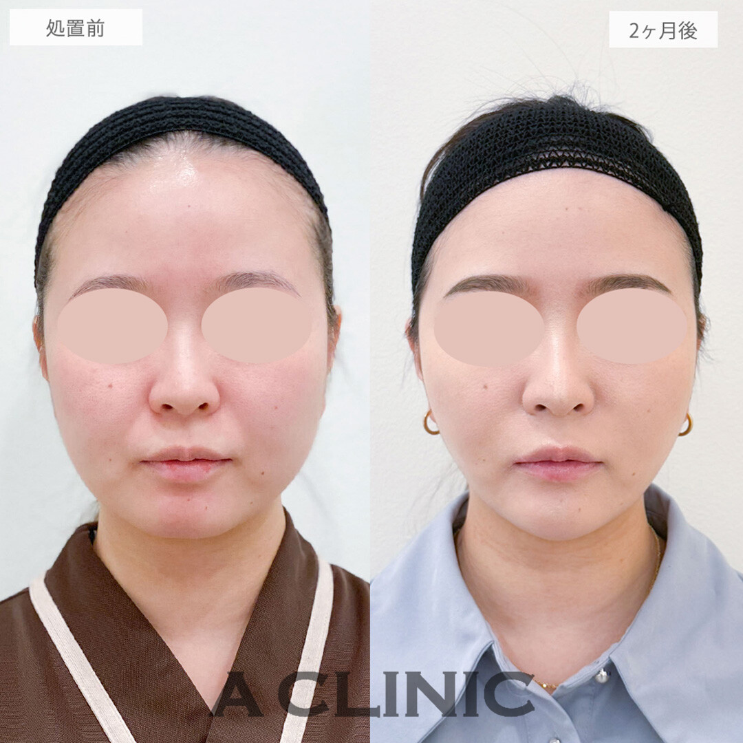 1day小顔脂肪吸引とバッカルファット除去術とナゾラビアルファット除去術と小顔エラボトックスとあごへのヒアルロン酸注入で骨切りいらずの理想の小顔を手に入れました！処置前と2ヶ月後の症例です(20代女性)