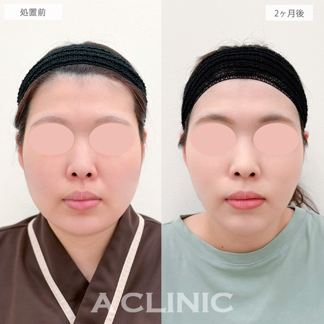 1day小顔脂肪吸引と小顔エラボトックスで下膨れ顔から輪郭美人に！処置前と2ヶ月後の症例です(30代女性)