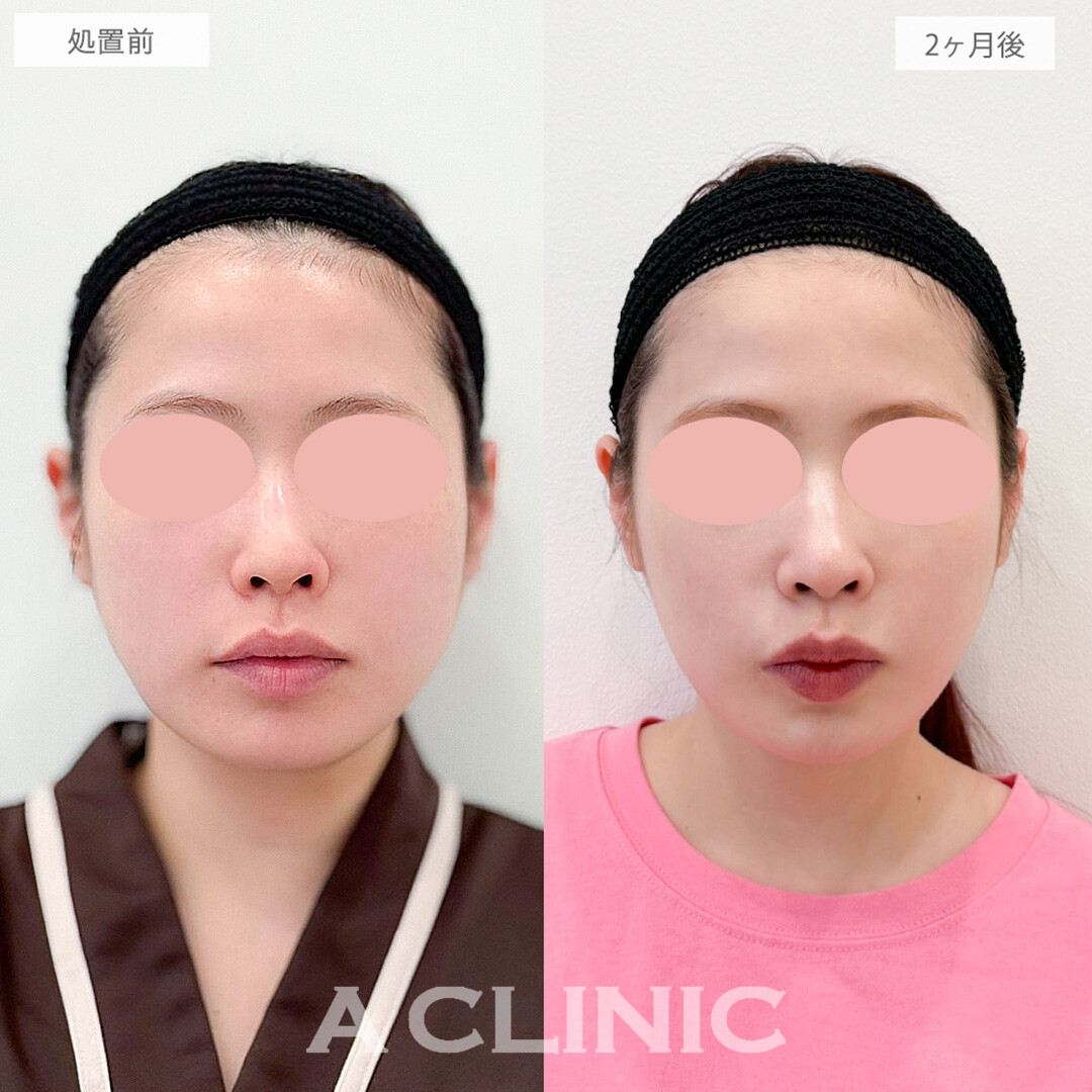 1day小顔脂肪吸引と小顔エラボトックスで顔の余白がなくなりスッキリ垢抜けた印象に！処置前と2ヶ月後の症例です(20代女性)