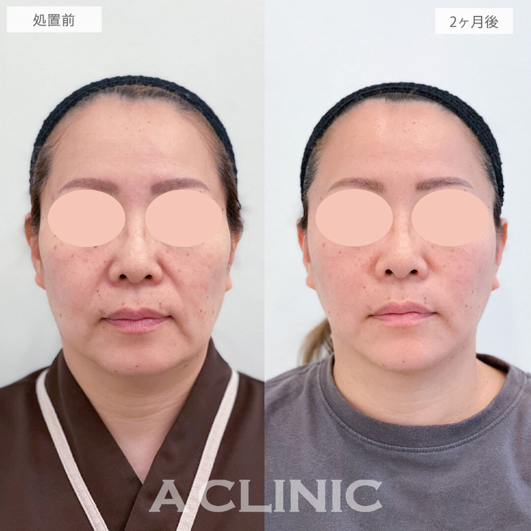 1day小顔脂肪吸引とあごへのヒアルロン酸注入とボトックス注射(しわ)でたるみとシワが改善され若々しい印象になりました！処置前と2ヶ月後の症例です(40代女性)