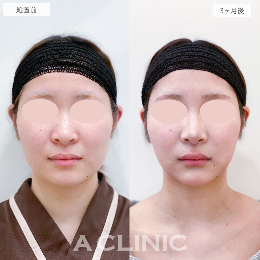 1day小顔脂肪吸引と小顔エラボトックスとあごへのヒアルロン酸注入で垢抜け輪郭が手に入りました！処置前と3ヶ月後の症例です(20代女性)