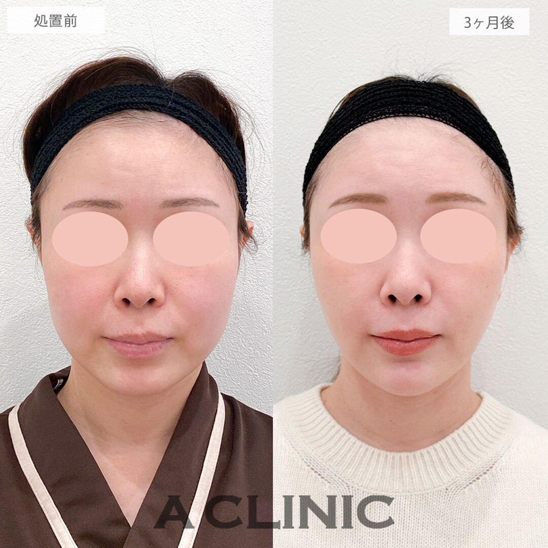 1day小顔脂肪吸引とバッカルファット除去術と小顔エラボトックスとあごへのヒアルロン酸注入でホホのたるみとボリュームがなくなりマイナス10歳若返りました！処置前と3ヶ月後の症例です(40代女性)