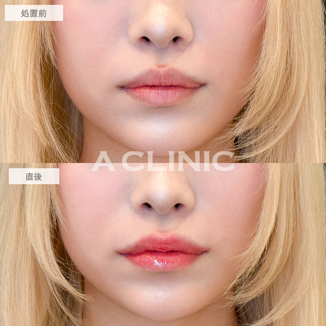 スマイルリップで加工後のような唇が手に入りました！処置前と直後の症例です(10代女性)