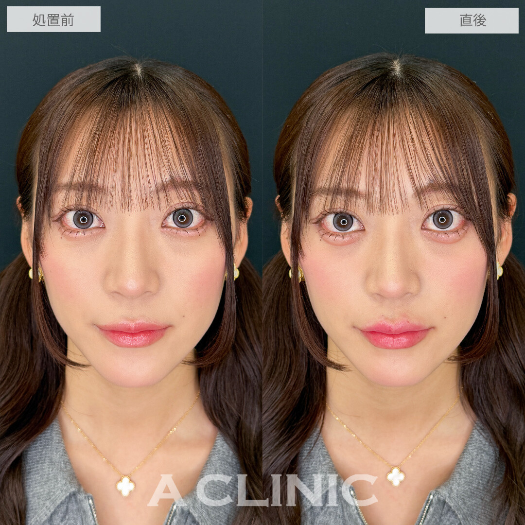 ヒアルで即日手軽に中顔面短縮！涙袋形成術(ヒアルロン酸)とリップヒアルロン酸注入の処置前と直後の症例です(20代女性)