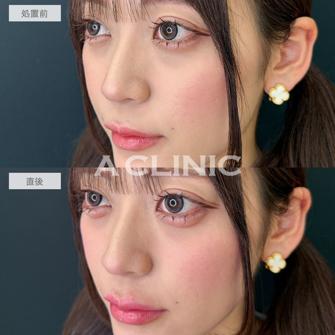 ヒアルで即日手軽に中顔面短縮！涙袋形成術(ヒアルロン酸)とリップヒアルロン酸注入の処置前と直後の症例です(20代女性)